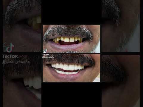 عاجي لطب الاسنان فرع الروضه تركيبات الاسنان تركيب تقويم شفاف تقويم الاسنان