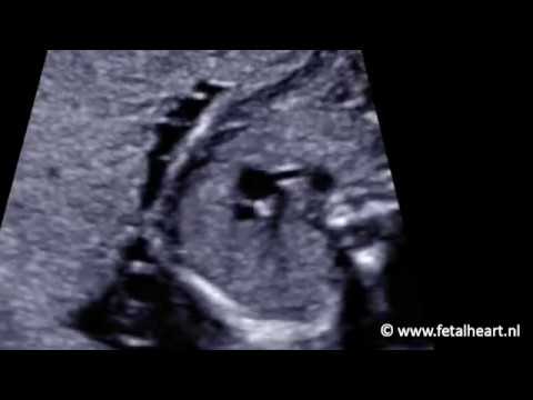 Truncus Arteriosus Fetal Ultrasound