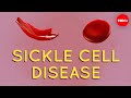 The Impact of Genetic Mutations on Sickle-Cell Disease and Red Blood Cell Function