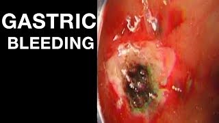 Gastric bleeding & Thermal therapy
