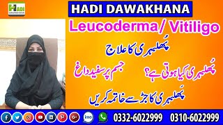 Phulbehri Bars Ka Ilaj Leucoderma Treatment پھلبہری کا علاج Vitligo Ka Ilaj Jism Pr Safeed Dagh
