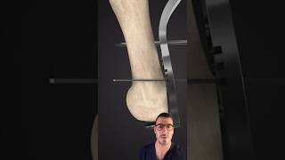 Powerful bunion correction