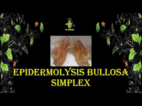 Video: Parameter Farmakokinetik Asas Diacerein Yang Terpakai Di Kalangan Pesakit Pediatrik Dengan Epidermolisis Umum Yang Teruk Bullosa Simplex