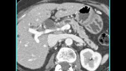 Abdomen: Pancreas: Staging of pancreatic cancer:Analysis of arterial and venous structures(5 of 11)