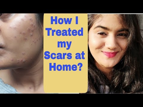 How to get rid of Acne scars, Fade Pimple marks & Pigmentation Solution | How to get Clear Skin