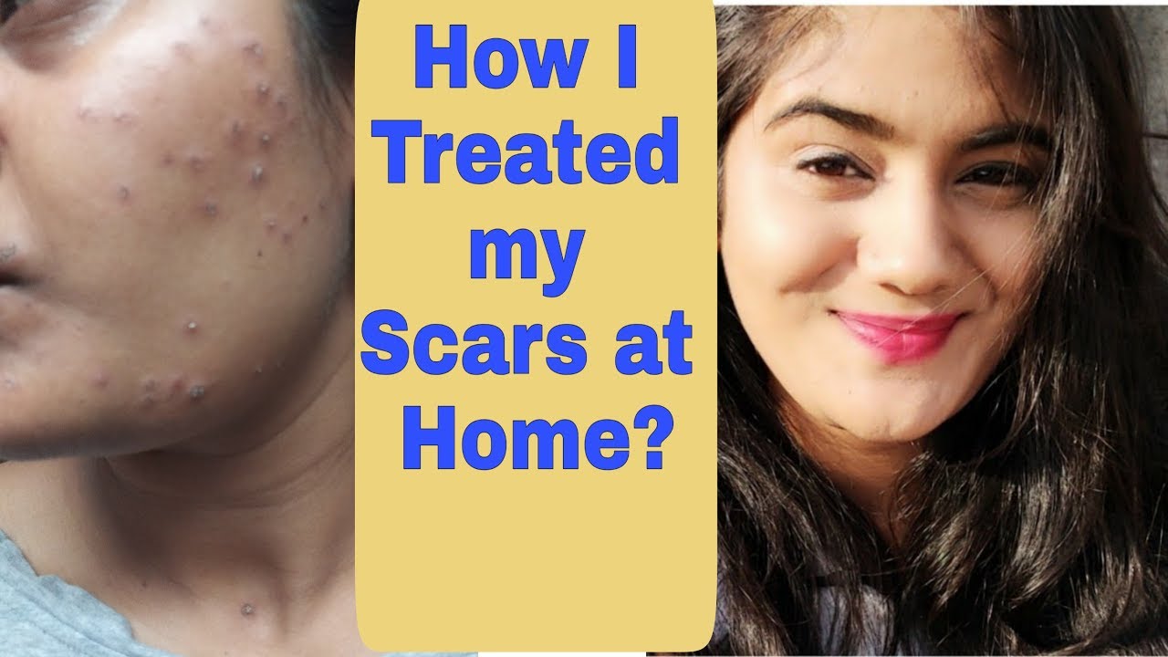 How to get rid of Acne scars, Fade Pimple marks & Pigmentation Solution | How to get Clear Skin