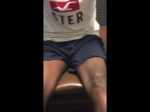 Testimonial: 1 month s/p hamstring ACL reconstruction with BMC (stem cell) injection