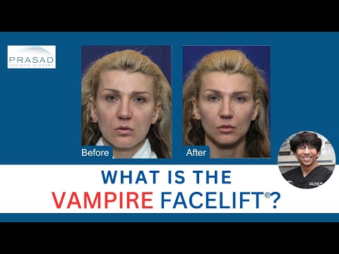 Vampire Facelift™: Not Just PRP Not a Facelift Replacement thumbnail