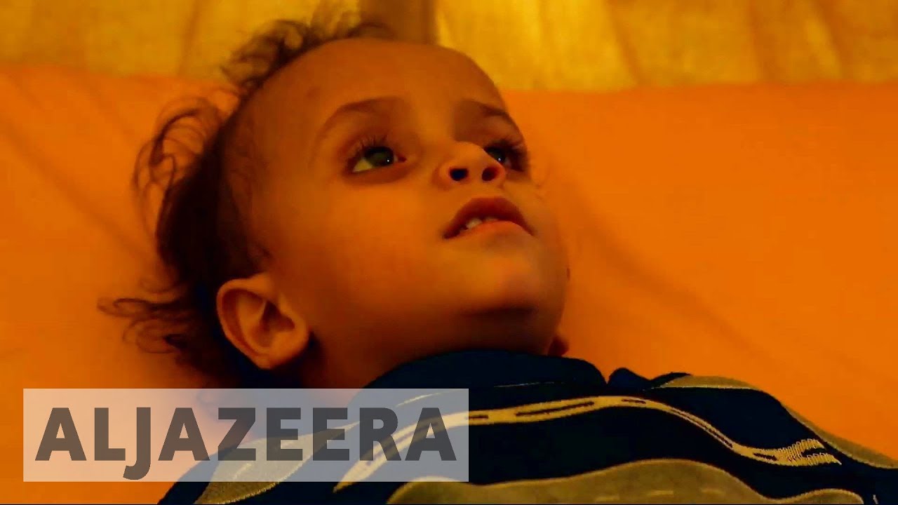 الأمم المتحدة: حالات الإصابة بالكوليرا في اليمن قد ترتفع إلى 300 ألف حالة
