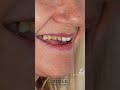 Smile transformation with allceramic crowns and dental bridges by drjohnson ozgur smiledesign
