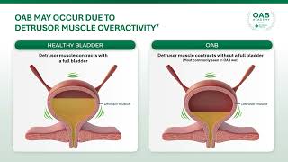 Fast Facts: What is OAB?