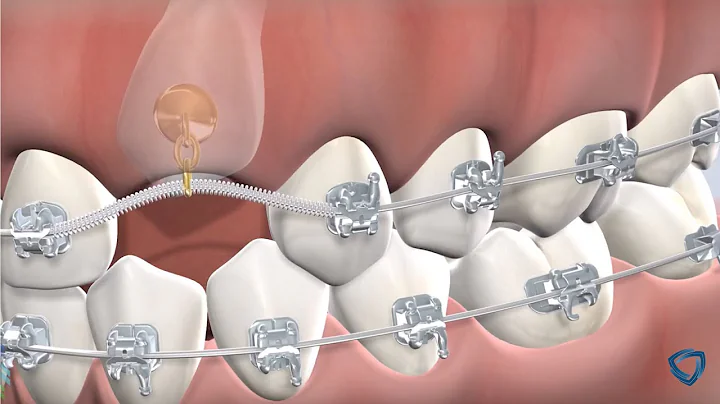 Exposure & Bonding in Kennewick WA: Dr. Reddinger ...