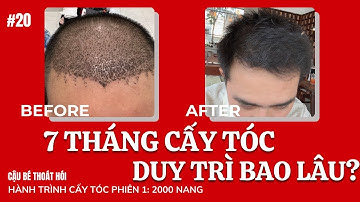 7 THÁNG cấy tóc DHI chữa hói TÓC CẤY DUY TRÌ BAO LÂU? #20 l Hành Trình Cấy Tóc
