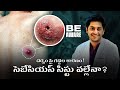 Learn about safe, scar-minimized, and painless treatment options for sebaceous cysts