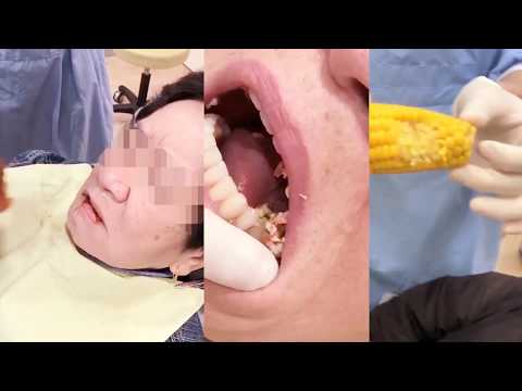 【日本BPS吸附性義齒】找回你遺失的食慾與笑容～能吃玉米的活動假牙👍️