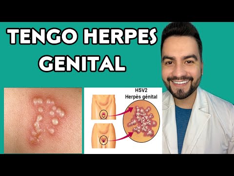 Video: ¿El panadizo herpético significa que tengo herpes?