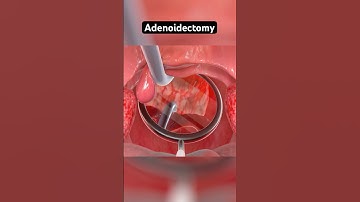 Adenoidectomy explained (3D Animation)