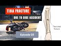 Tibia and fibula fractured Ep. 03: Exercises and Nutritions