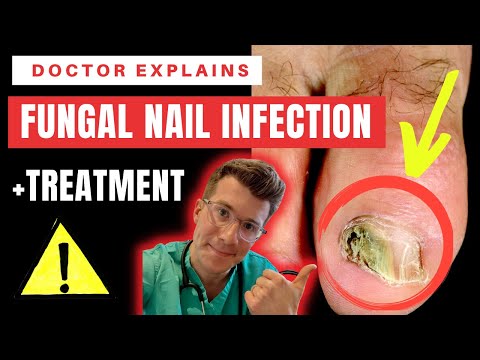 Fungal nail infections | Healthify