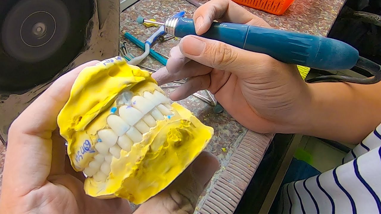 Hé lộ cách làm răng Sứ thẩm mỹ, răng toàn sứ, răng sứ kim loại hiện đại ...