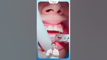 Bước Quan Trọng Sau Khi Tháo Mắc Cài | Nha Khoa Minh Châu