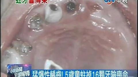 【中視新聞】父母齲齒細菌 體質遺傳.唾液傳寶寶 20140318 - 天天要聞