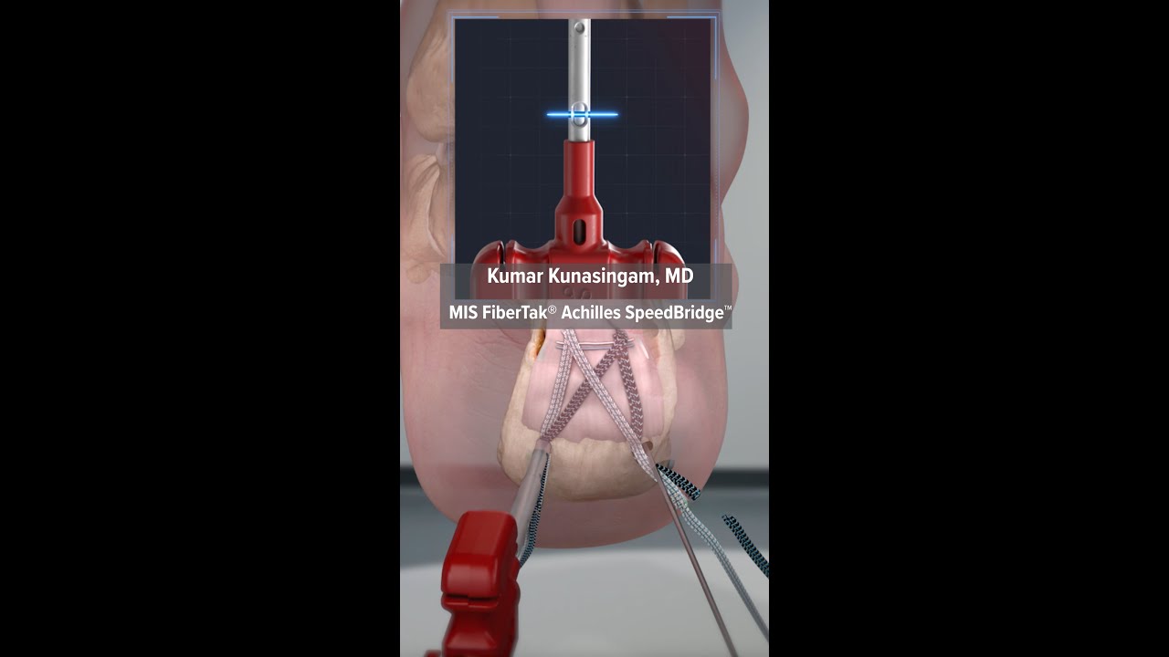 Arthrex MIS FiberTak&reg; Achilles SpeedBridge&trade;
