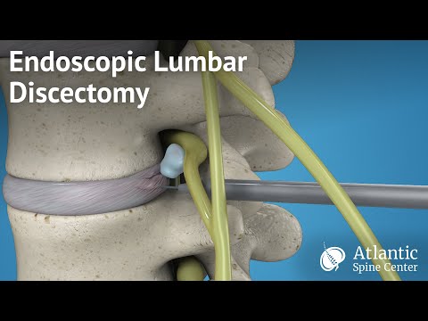 Endoscopic Lumbar Discectomy. 