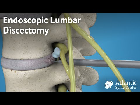 Penyakit hernia nukleus pulposus (Penyakit hernia nukleus pulposus (HNPPenyakit hernia nukleus pulpo. 