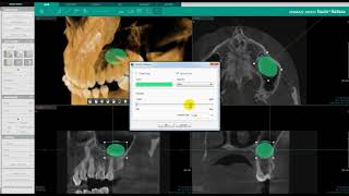 Volume Measuring | Ez3D-i | Vatech