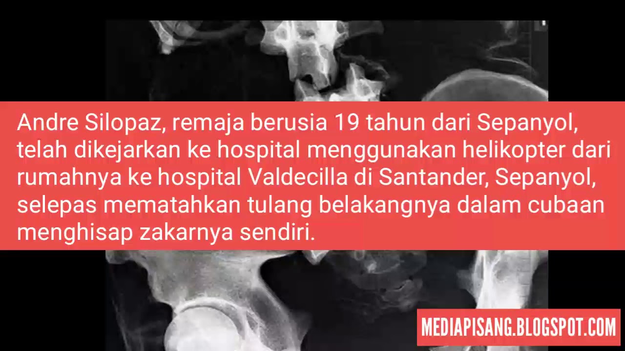 Cubaan Hisap Zakar Sendiri Remaja Hampir Mati Patah Tulang Belakang Youtube