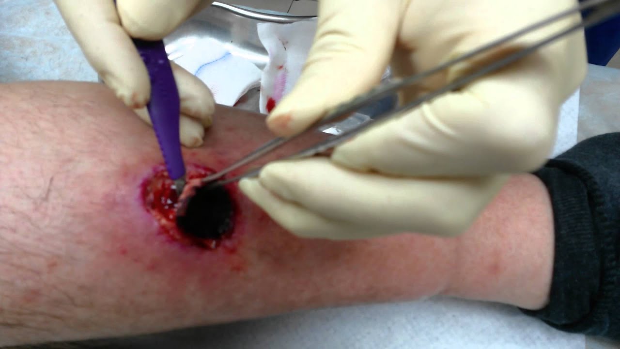 Иссечение некроза кожи при ожоге 4 степени.