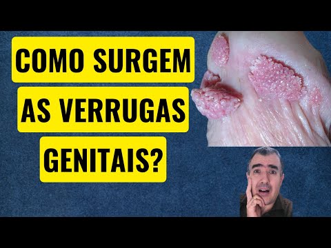 Como surgem as verrugas genitais