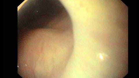 Nutcracker Esophagus