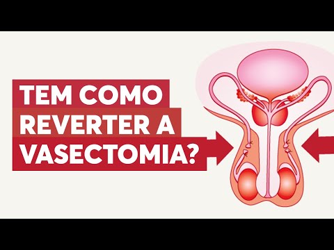 Vídeo: A vasectomia pode ser revertida?