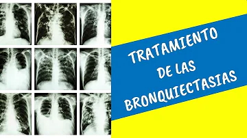 ¿Cómo eliminar bronquiectasias?