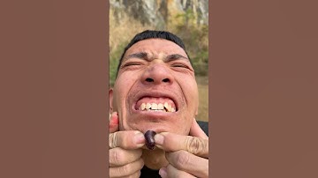 How I Cured a Bug Bite with Yogurt in the Wild | Survival Hacks