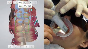Trios 3 Shape training video - bite registration and open bite registration for a splint. Episode 3