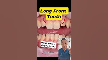 Fixing Long Front Teeth: Top 2 Options! #dentallan #dentist #shorts