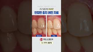 주변 치아의 손상 없이 충치만 제거하는 레진 치료 #임플란트 #명동시스템치과 #시스템치과