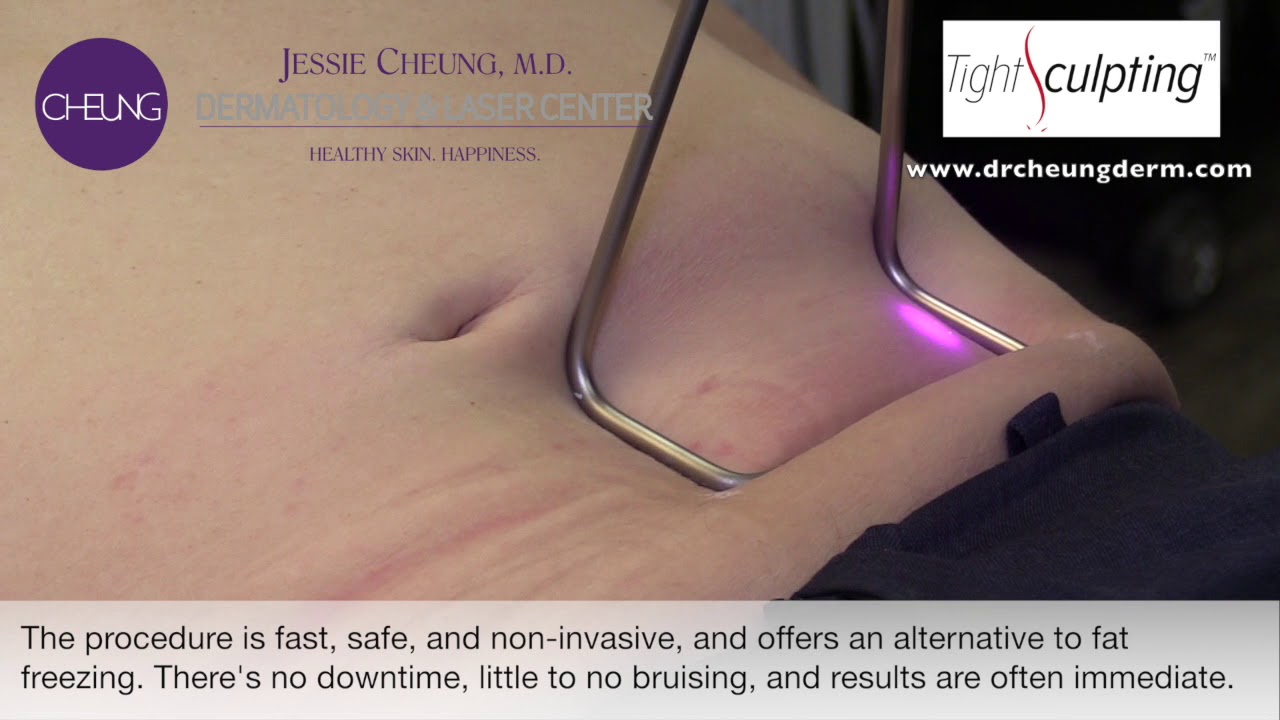 TightSculpting® - A non-invasive way to lift and tighten skin!