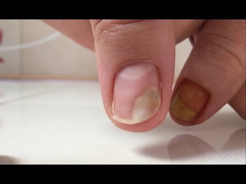 Tratament ciuperca unghiilor.  (CC Eng Sub) Vă arăt practic cum se procedează. (Nails fungus)