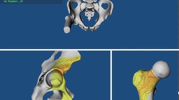 Patient with Hip Pain and Anterior Extraarticular Subspine Hip Impingement with low femoral version