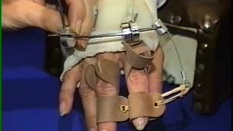 I - Dynamic Extension Splint for Metacarpophalangeal Joints Part 3