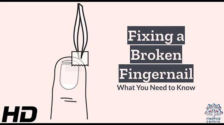 Fix Your Broken Fingernail with These Effective Remedies