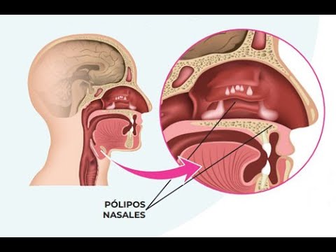 Quitar pólipos nasales sin cirugía