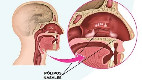 ¿Los pólipos nasales hacen que apeste el aliento?