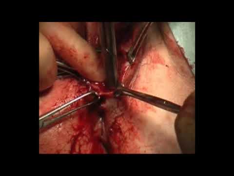 REPAIR OF ANAL SPHINCTER WITH OBVIOUS SUBCUTANEOUS SEPARATION