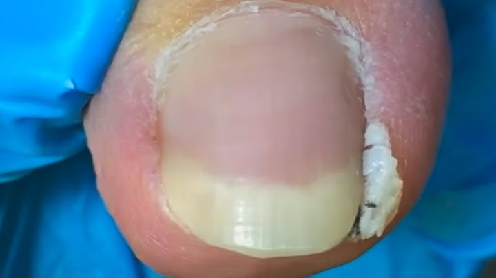 If You Have Very Long Toenails, Just Cut Off The Ingrown Toenails!