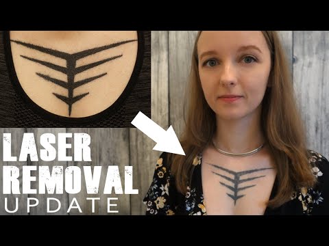 Laser Tattoo Removal: